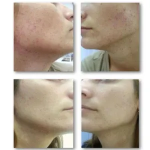 Zmatňujúce tonikum pre mastnú a problematickú pleť Acnaut Biotrade 60ml