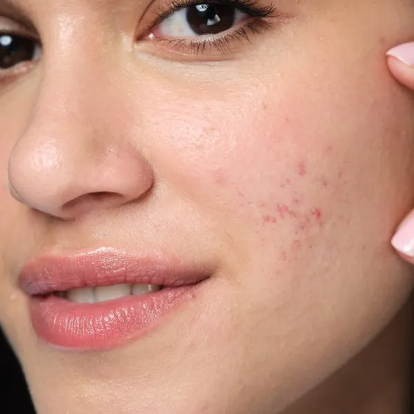 Neutrogena Clear & Defend+ chemický peeling 125 ml