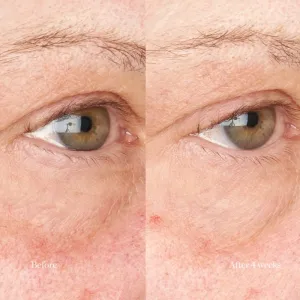 Perricone MD Hypoallergenic Clean Correction Eye Cream hydratačná a rozjasňujúca starostlivosť na očné viečka a kruhy pod očami 15 ml