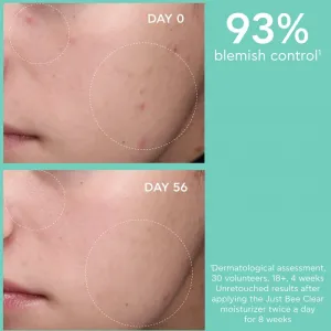 Apivita Just Bee Clear Blemish Control Moisturizer hydratačný krém na tvár s niacínamidom 40 ml