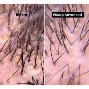L´ORÉAL Professionnel Séria Expert Scalp Advanced Šampón proti lupinám 300 ml