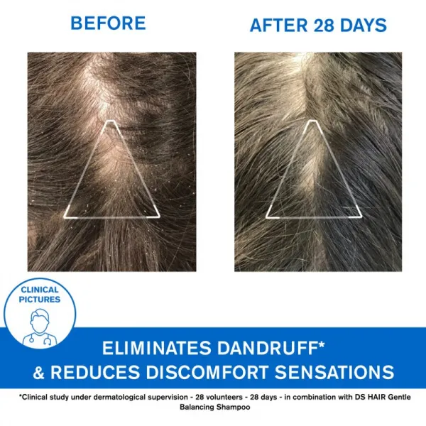 Uriage DS HAIR Anti-Dandruff Treatment Shampoo šampón proti lupinám pre podráždenú pokožku hlavy 200 ml