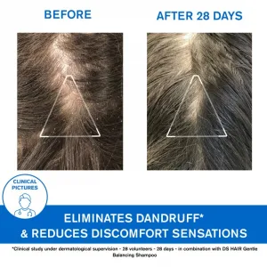 Uriage DS HAIR Anti-Dandruff Treatment Shampoo šampón proti lupinám pre podráždenú pokožku hlavy 200 ml