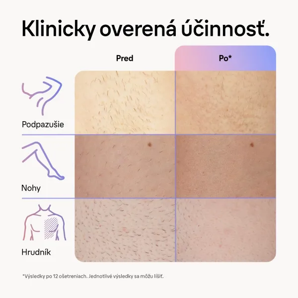 Braun Smart Skin Expert IPL7147 inteligentné IPL zariadenie na odstránenie chĺpkov na telo, tvár, oblasť bikín a podpazušia 1 ks