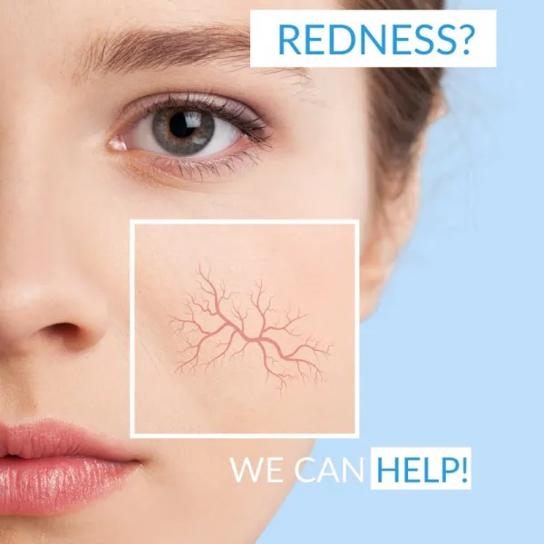 Dermedic Redness Calm upokojujúca čistiaca pena 150 ml