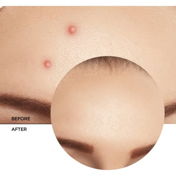 Revox B77 Zitcare AHA BHA PHA Spot Treatment lokálna starostlivosť proti akné 25 ml