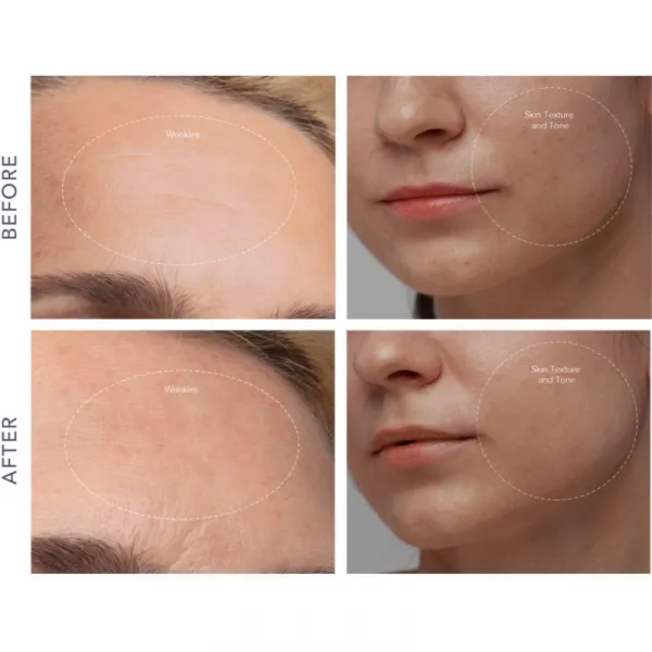 FOREO KIWI™ Derma zariadenie na diamantovú mikrodermabráziu a čistenie pórov 1 ks