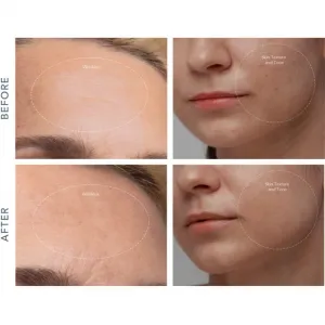 FOREO KIWI™ Derma zariadenie na diamantovú mikrodermabráziu a čistenie pórov 1 ks