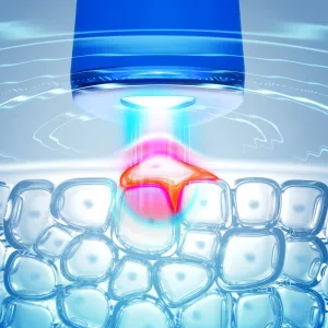 FOREO ESPADA™ 2 pero s modrým svetlom pre zmiernenie prejavov akné Cobalt Blue 1 ks