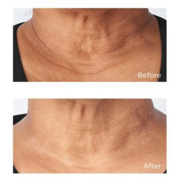 Perricone MD Cold Plasma Plus+ Sub-D/Neck spevňujúci krém na krk a dekolt 59 ml