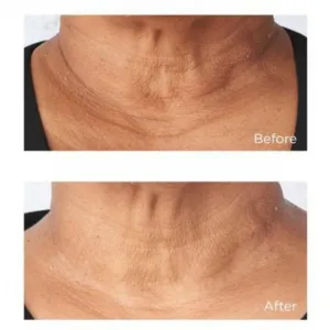 Perricone MD Cold Plasma Plus+ Sub-D/Neck spevňujúci krém na krk a dekolt 59 ml