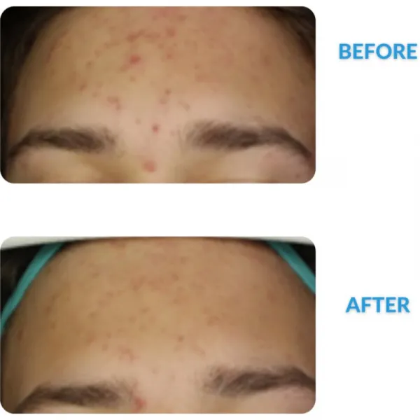 Dermedic Redness Calm krém proti začervenaniu pokožky a rozšíreným žilkám 40 ml