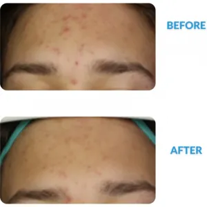 Dermedic Redness Calm krém proti začervenaniu pokožky a rozšíreným žilkám 40 ml