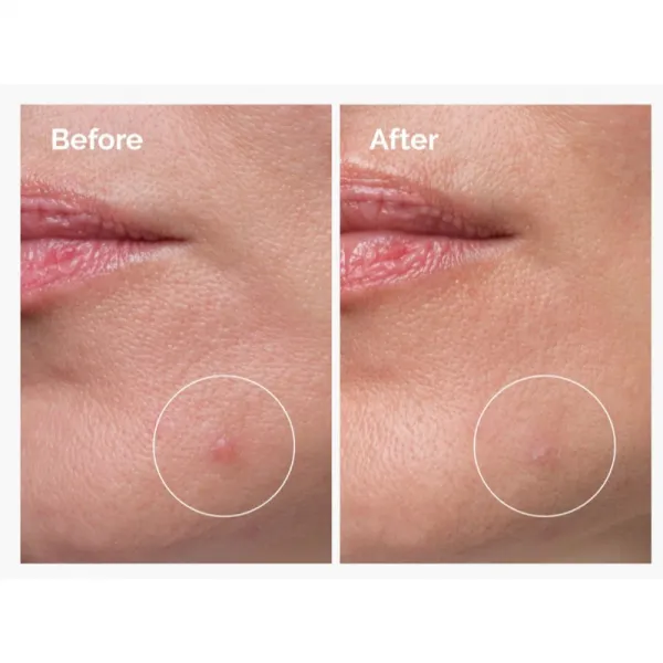The Ordinary Sulfur 10% Powder-to-Cream Concentrate lokálna starostlivosť proti akné 5 g
